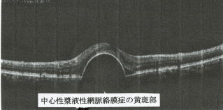 中心性漿液性網脈絡膜症